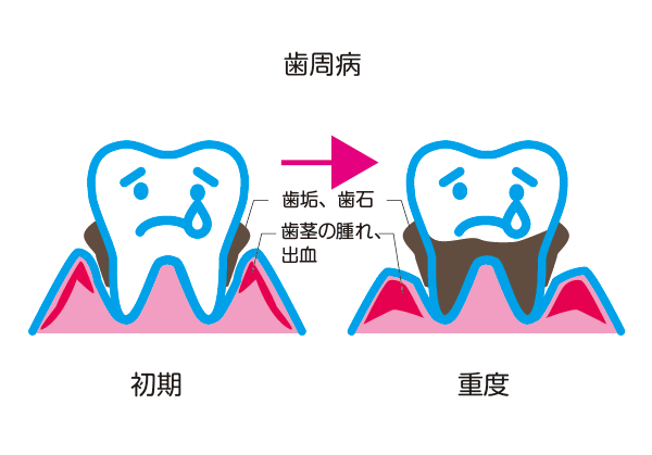 歯周病の図解