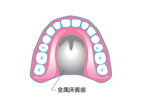 レジン床義歯　金属床義歯